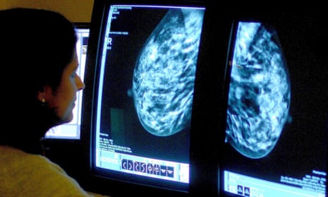 A consultant analyses a mammogram.