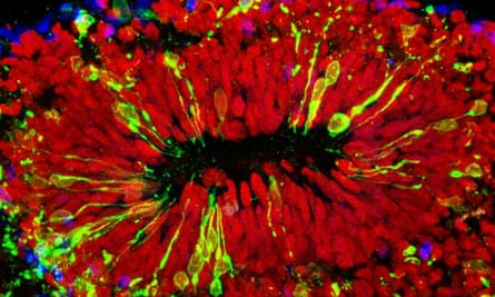Cerebral organoid infected with Zika virus (green), showing vulnerable neural stem cells (red).