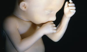 A human foetus at approximately 20 weeks gestation. In recent decades the limit of viability for premature babies has been pushed back to about 23 weeks.