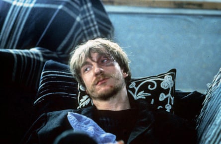 a man with a bruised eye with his head resting on a pillow