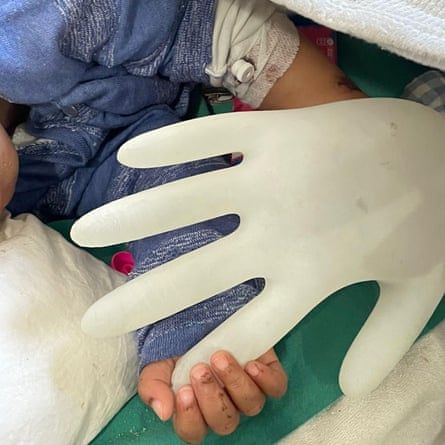 Three-year-old Nour clings to an inflated glove