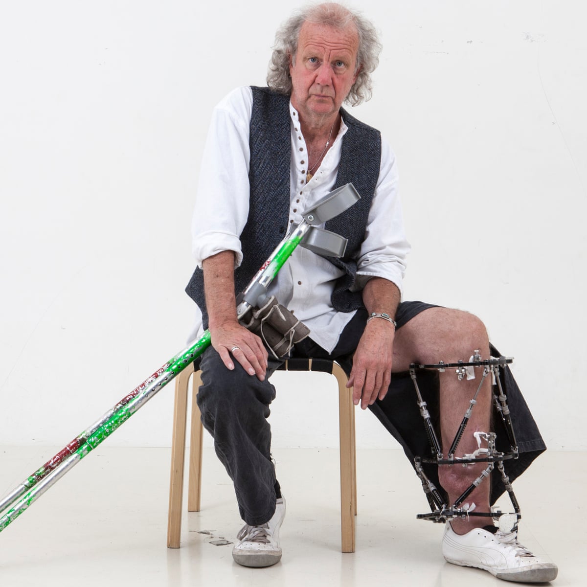 how comrade ilizarov saved my leg health the guardian how comrade ilizarov saved my leg health the guardian