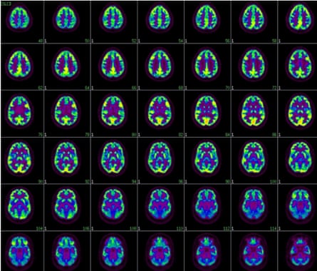 PET images of Northington’s brain. The report states that ‘results of neuropsychological testing ... converge to show abnormalities indicating brain damage.’