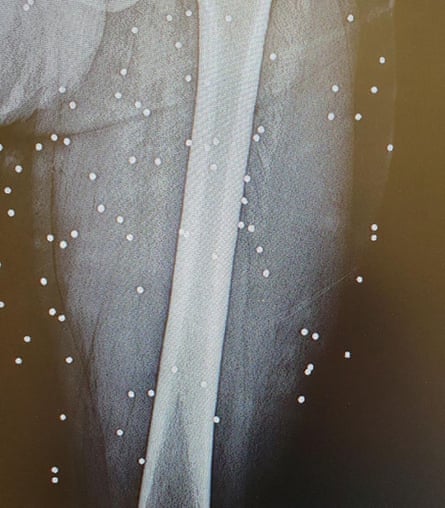 X-ray of a thigh with dozens of white dots embedded in it