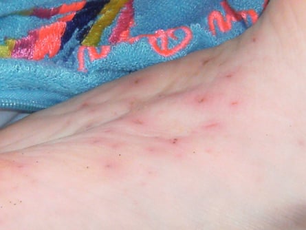 Knight’s foot, with about a dozen red marks where it has been pierced by the sea urchin’s spines.
