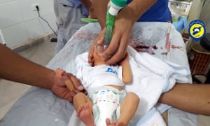 baby receives treatment with mask over its face
