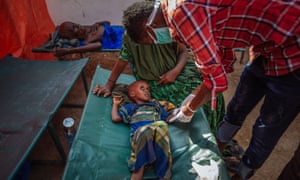 A malnourished Somali child from a refugee camp in the town of Doolow, on the border with Ethiopia, receiving treatment.