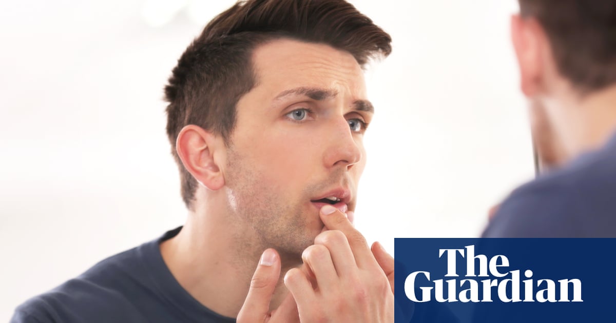 Modern herpes variants may be linked to bronze age kissing, study finds