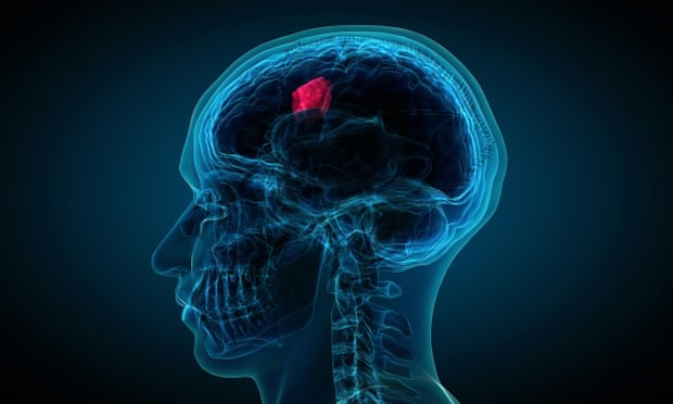 Scan of head in profile with tumour highlighted in red