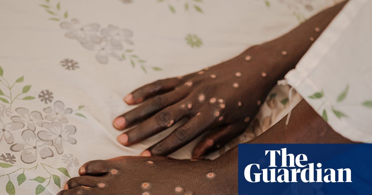 Mpox is back – and in new countries. How can this outbreak be contained?