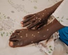 Mpox is back – and in new countries. How this outbreak can be contained