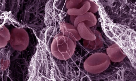 This image shows the components of a blood clot.
