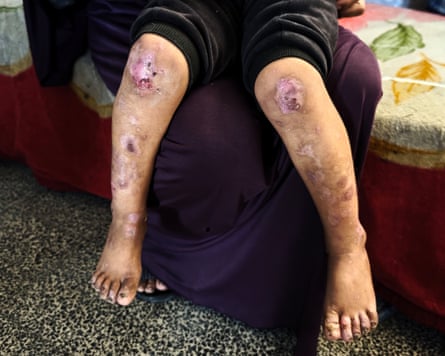 Sores on a young boy’s legs as he sits on his mother’s knee.