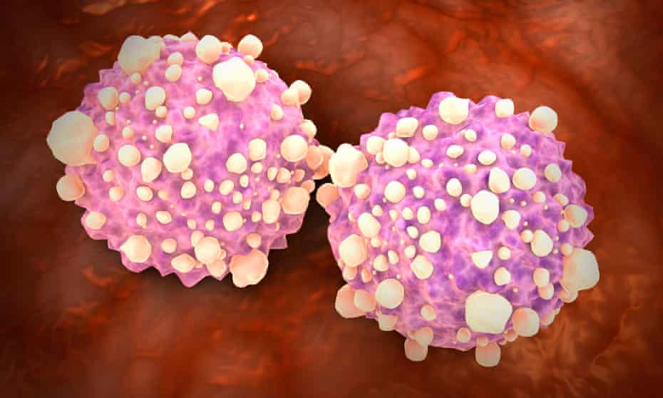 Pancreatic cancer cells. The AI-based system detected 63% of stage I pancreatic cancers, and 100% at stage IV in the study