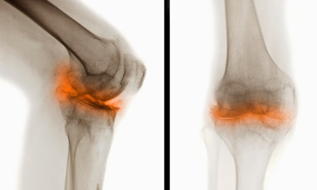 Knees are good ... although this one is showing signs of severe degenerative osteoarthritis.