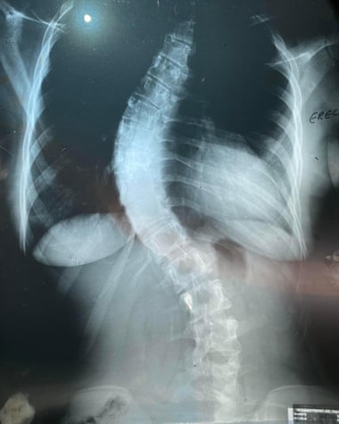 Nicola Sharp-Jeffs’ X-ray of her spine before surgery.
