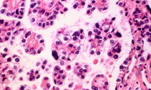 Ovarian cancer cells