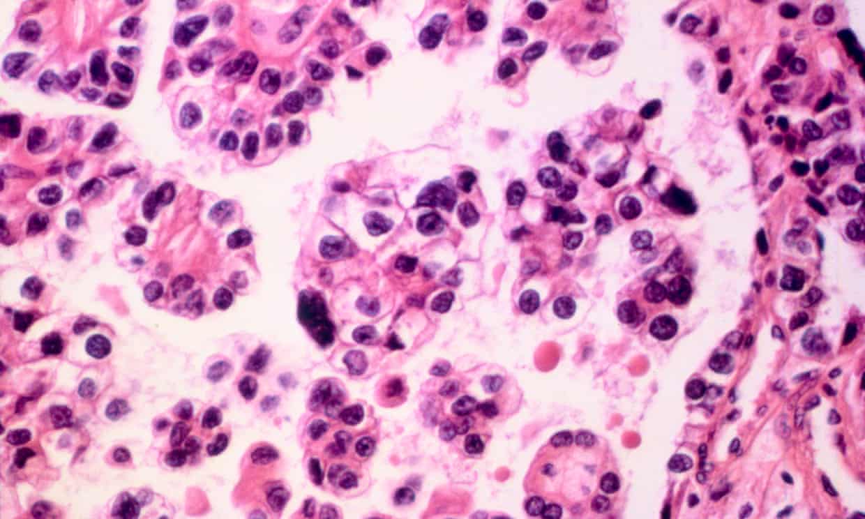 Doctors welcome 'Holy Grail' of cancer research