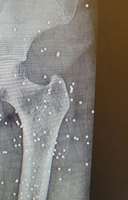 X-ray of a thigh and pelvis with dozens of white dots embedded