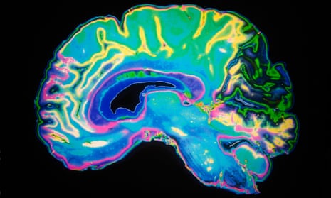 An MRI scan of a human brain. Work on the new compound is at a very early stage, but raises hopes for new drugs to halt the progression of Alzheimer’s.