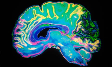 brain scan MRI image