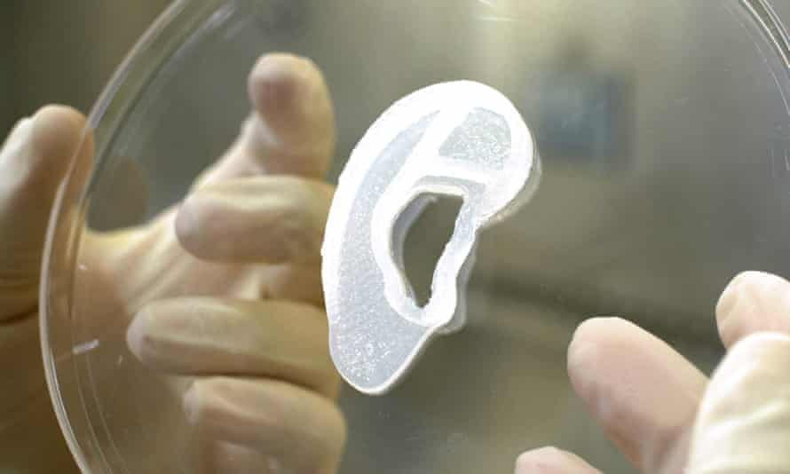 A 3D bioimplant of an earlobe