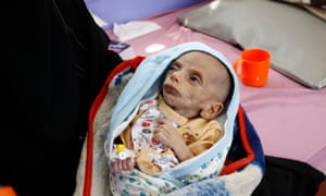A malnourished child in Sana’a Yemen. Yemen has been ravaged by years of war and famine, and the global response to food insecurity has been “dangerously inadequate” Oxfam has warned.