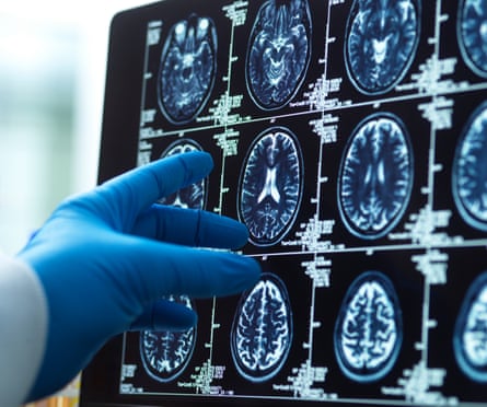 Doctor viewing a brain scan for possible ageing and disease.
