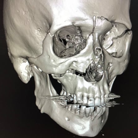 Pre-op CT scan image of Bell’s skull