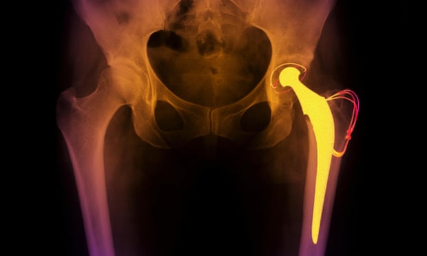 Hip implant in xray