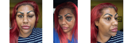 Three images of a female whose look is swollen and bruised aft counterfeit cosmetic treatment