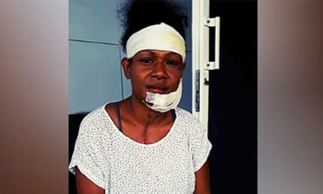 Debbie Kaore, an international rugby player and boxer, has shared an image of herself after being allegedly beaten with an iron by her partner in a domestic attack.