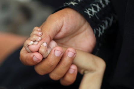 Close up of a mother’s hand holding the hand of her malnourished child