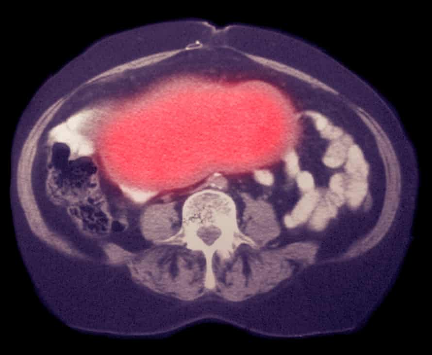 Ovarian cancer on CT scan