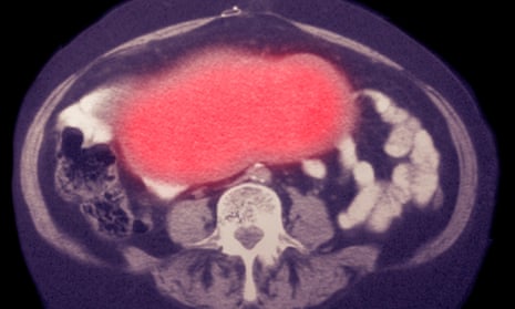 Ovarian cancer on CT scan.