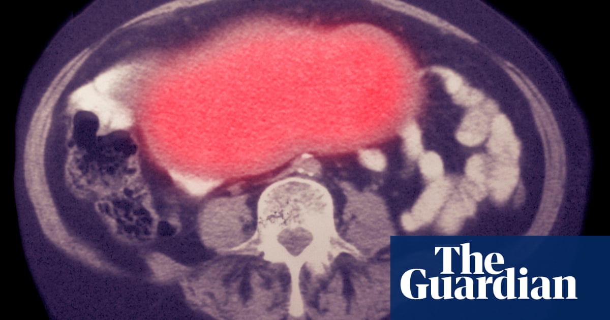 GSK teams with King’s College to use AI to fight cancer
