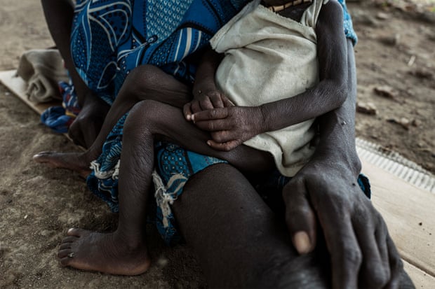 A mother sits with her malnourished child at a hospital in Tonj, Sudan