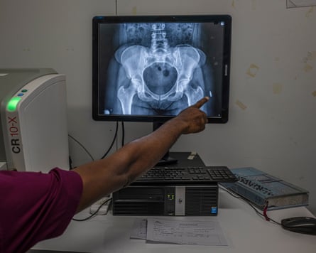 Someone points to an X-ray of a pelvis with a bullet in the upper leg