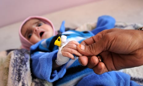 A malnourished baby receives treatment at al-Sabaeen hospital in Sana’a, Yemen
