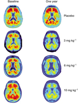 Comparison brain scans, with amyloid beta protein shown in red. The different dosages of aducanumab being tested are shown on the right.