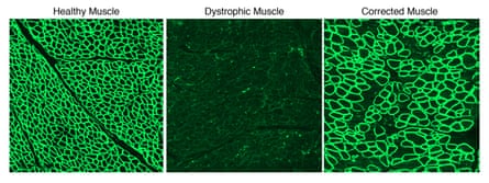 Single Cut CRISPR strategy restores the dystrophin protein. The images illustrate dystrophin (in green) in a healthy diaphragm muscle (left), absence in a canine model of Duchenne muscular dystrophy (center), and restoration of dystrophin in animals treated with CRISPR/Cas9 (right).