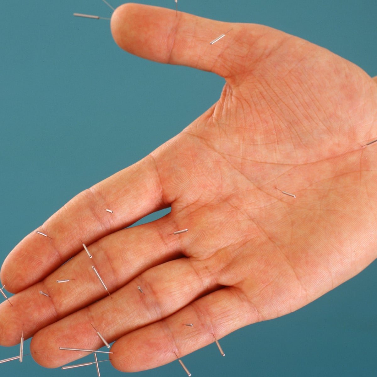 Acupuncture For Fertility In Encino