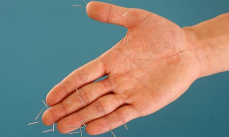 Hand with acupuncture needles in it