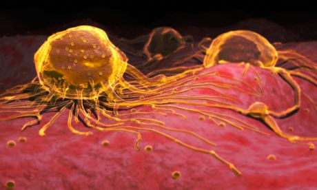 A graphic of how microscopic breast cancer cells would look.