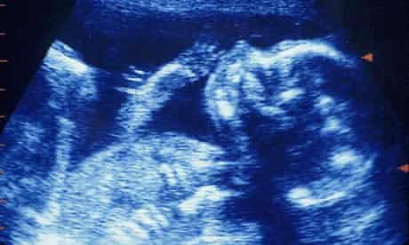 Ultrasound scan of foetus 