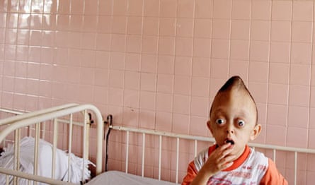 vietnamese boy with deformities caused by defoliants