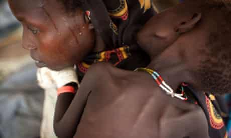 MDG : Child mortality : South Sudan : Severe Acute Malnutrition Batil refugee camp