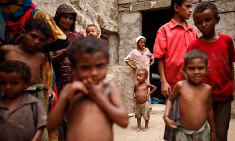 MDG : hungry people malnourished : One million Yemeni children face severe malnutrition, Yemen
