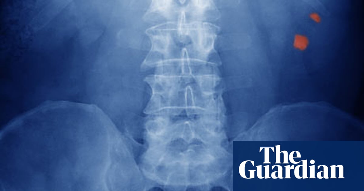 I've seen big men reduced to tears' | Kidney stones | The Guardian
