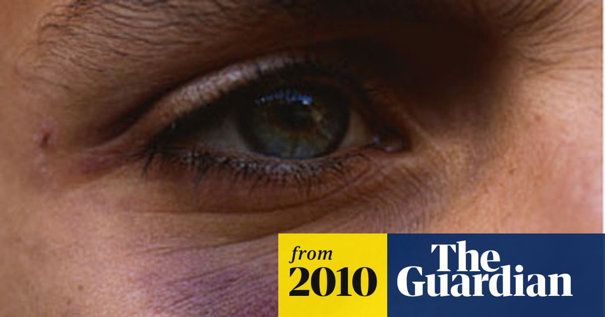 How to Prevent Black Eye After Injury: Effective Tips